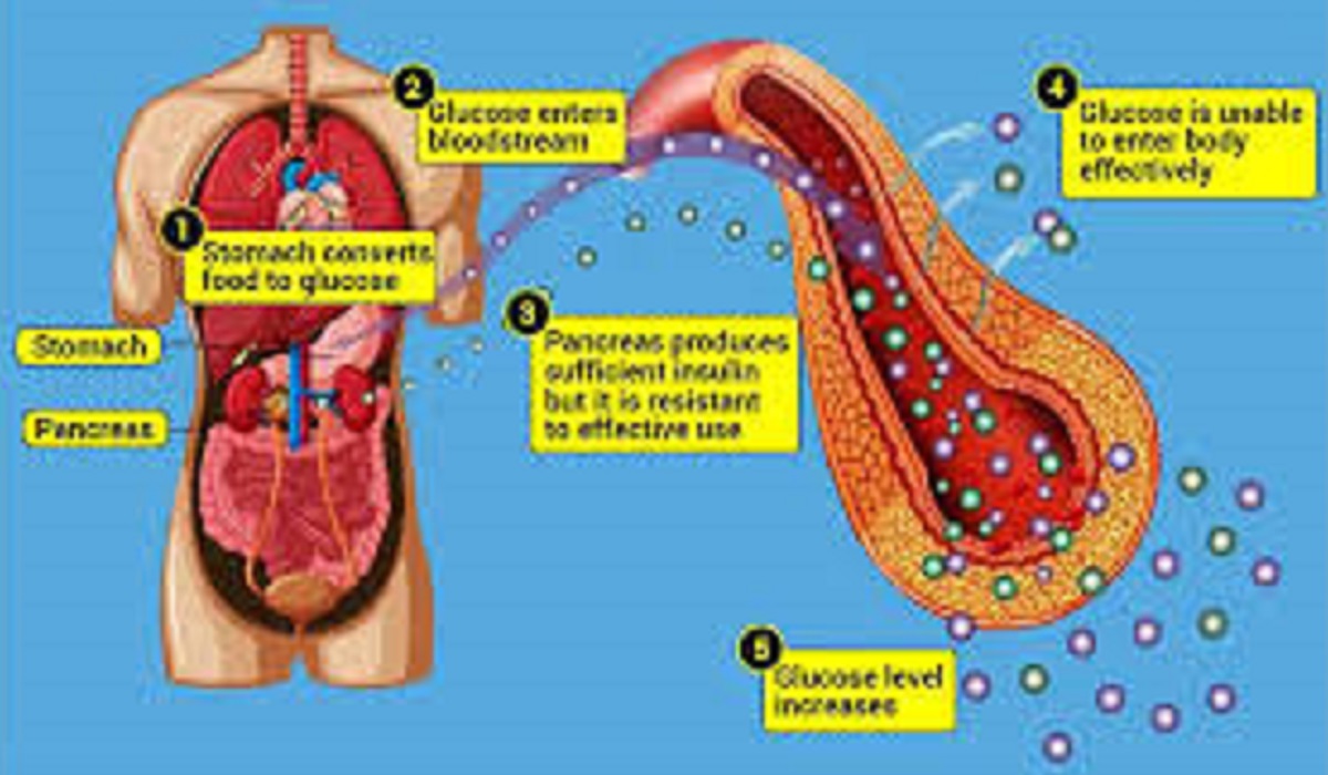 1st Type of Diabetes – Symptoms & Treatment with Examples – Latest