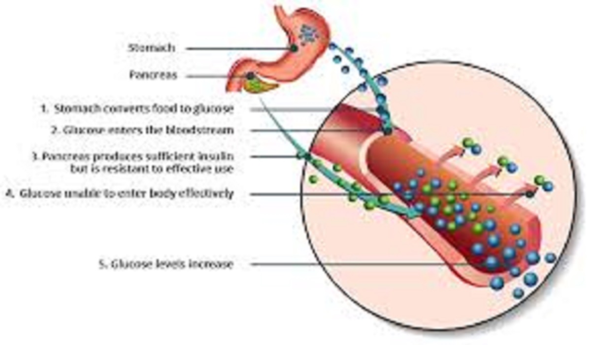 2nd Type of Diabetes & Symptoms with Examples – Latest
