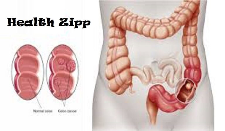 7 Symptoms of Colon Cancer with Examples – Latest