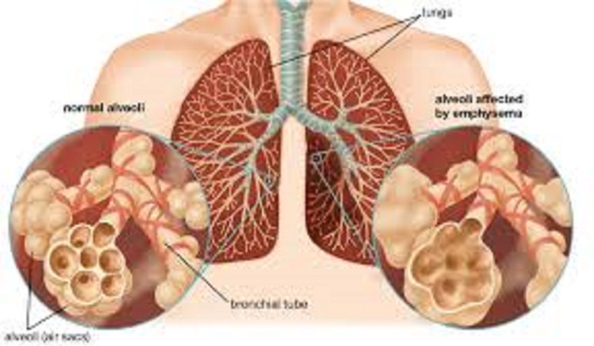 Asthma vs Lung Diseases & Their Symptoms with Examples – Latest