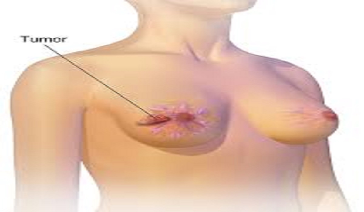 Breast Cancer: Symptoms and Examples - Latest 2025